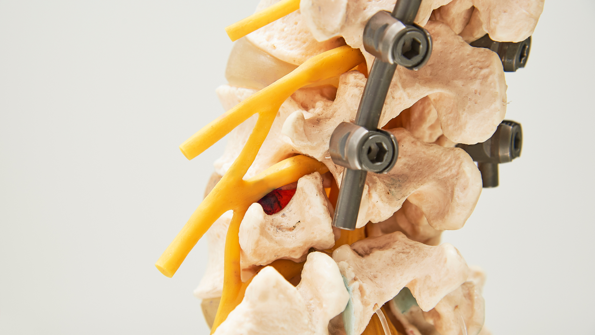 Spinal fusion