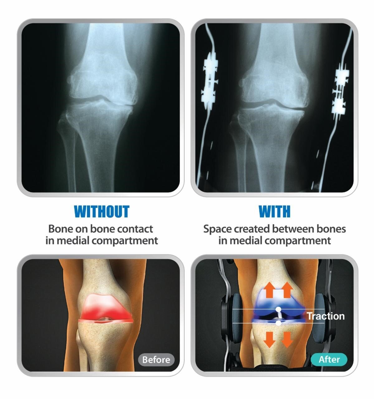 DDS OA Pro Knee Brace